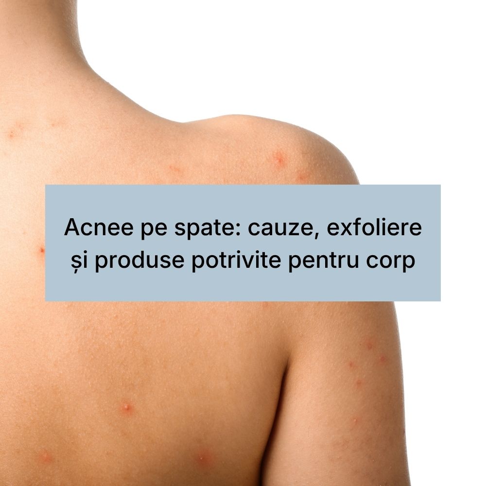 Acnee pe spate cauze, exfoliere și produse potrivite pentru corp